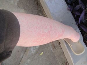 Matthew said the rash felt reptilian.  Again, awesome.